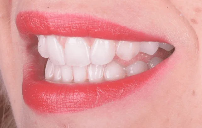 Sorriso laterale finale dopo il trattamento con approccio MTM