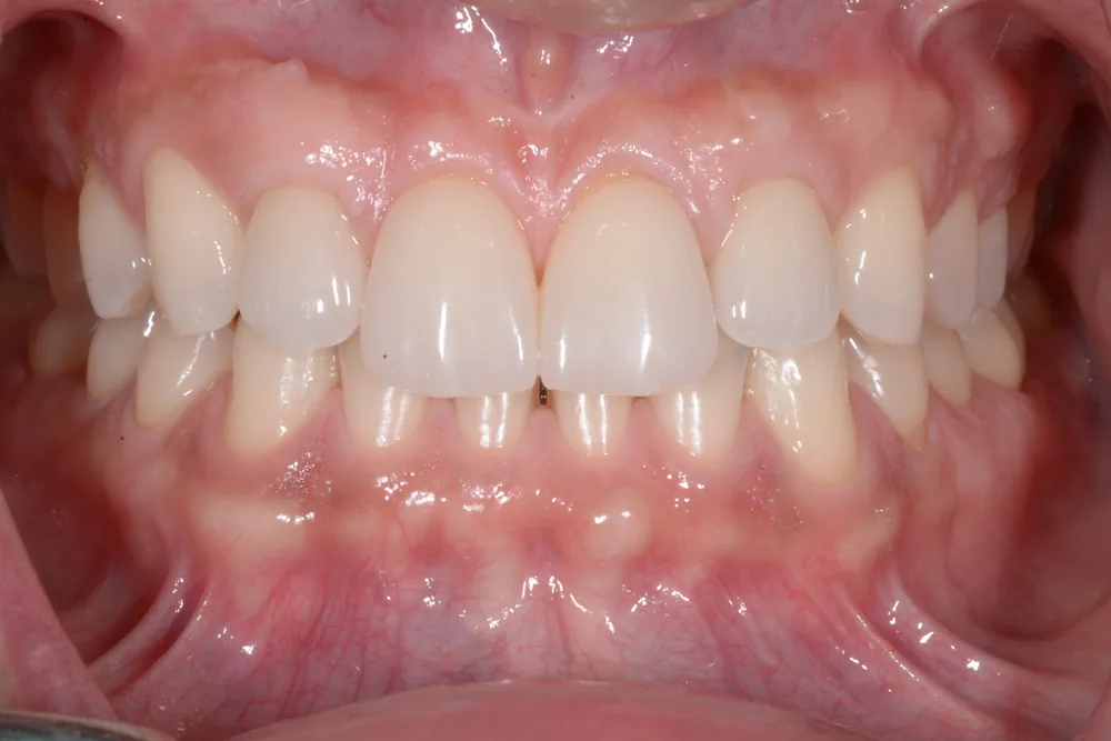 Sorriso completo in occlusione dopo il trattamento con approccio MTM