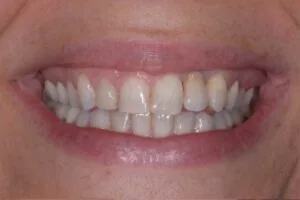 Sorriso iniziale prima del ritrattamento